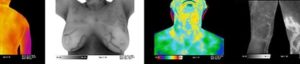 benefits of Thermography